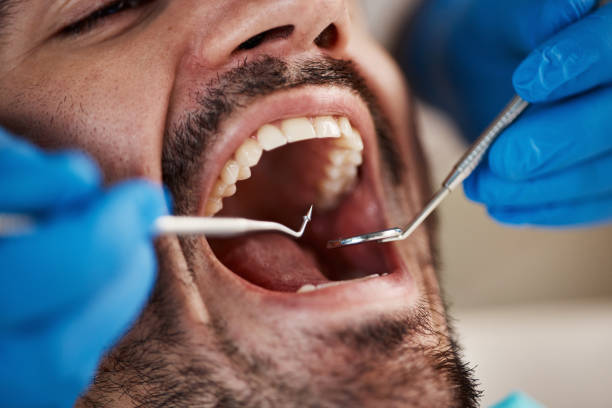 Best Emergency Wisdom Teeth Removal in Corpus Christi, TX